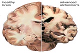 Image showing two halves of a brain comparing diseased alzheimers with healthy